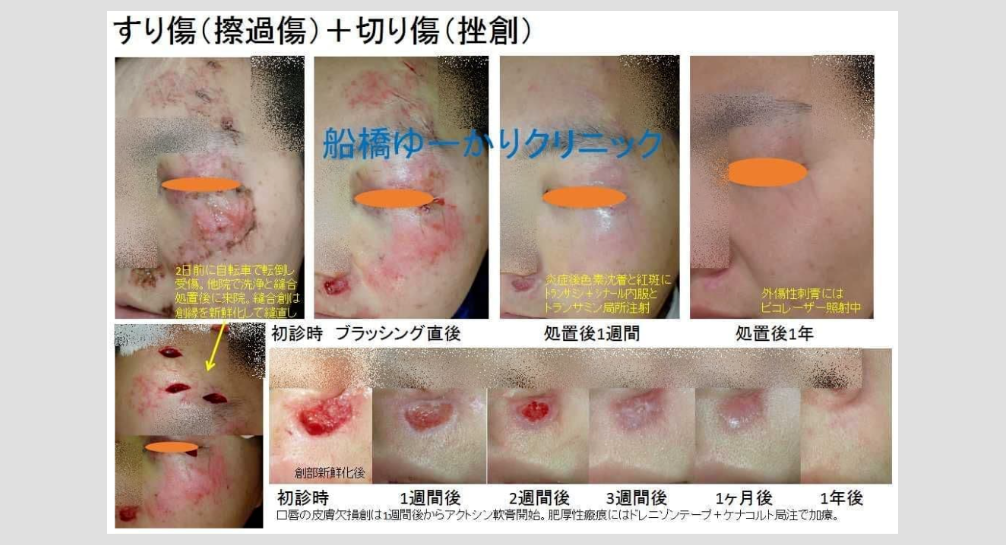 擦過傷治療症例3