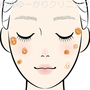日光性色素斑のイラスト