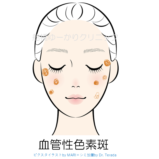 日光性色素斑のアイコン
