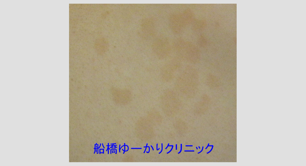 癜風の症例