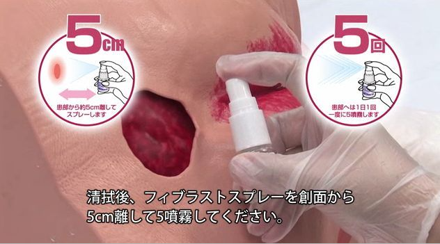 フィブラスト処置イメージ