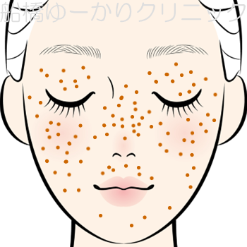 そばかすの出やすい部位のイメージ（眼瞼・頬・鼻・口唇など）