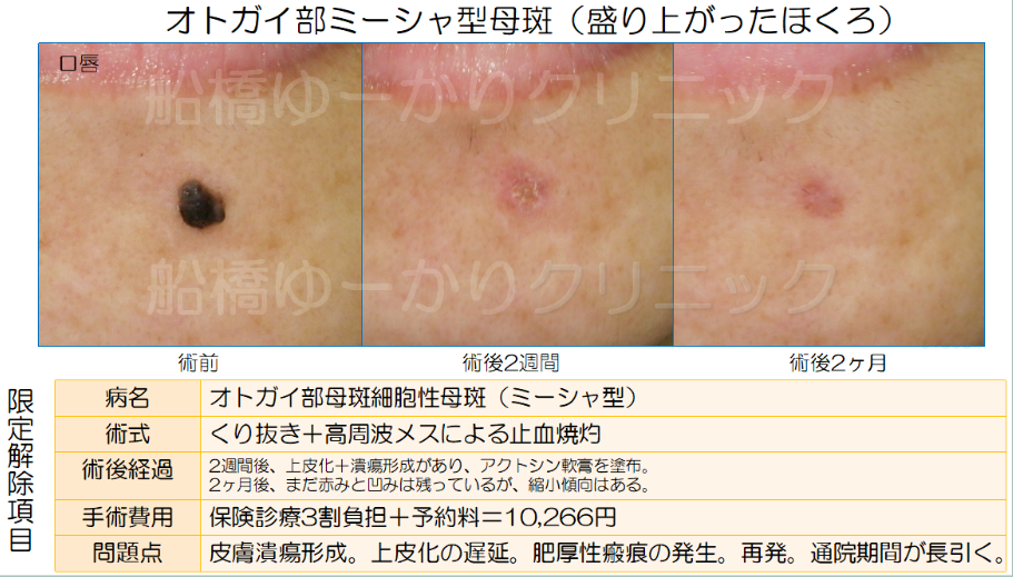 オトガイ部ミーシャ型母斑