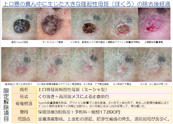 上口唇の真ん中に生じた大きな隆起性母斑（ほくろ）の除去後経過