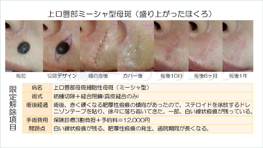 口唇部ミーシャ型母斑