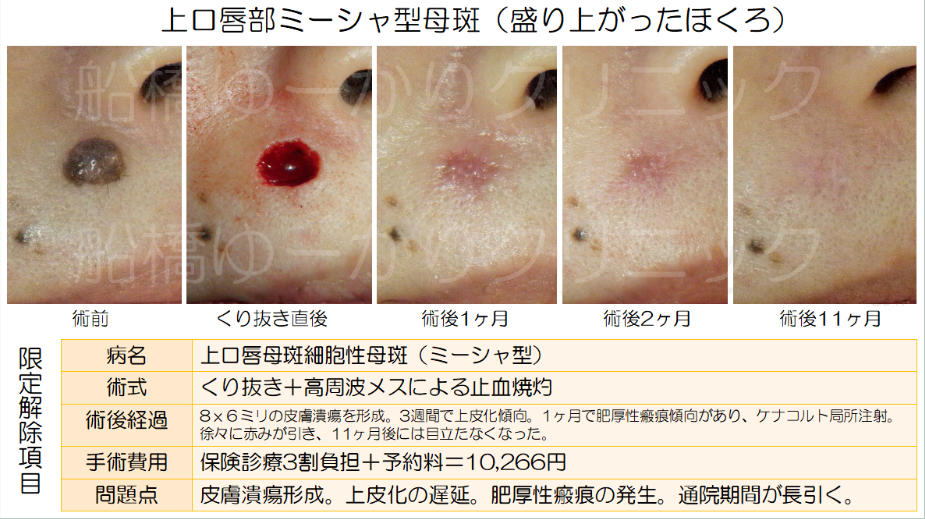 上口唇ミーシャ型母斑