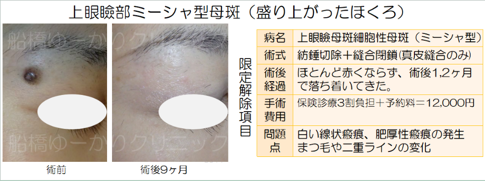 上眼瞼部ミーシャ型母斑