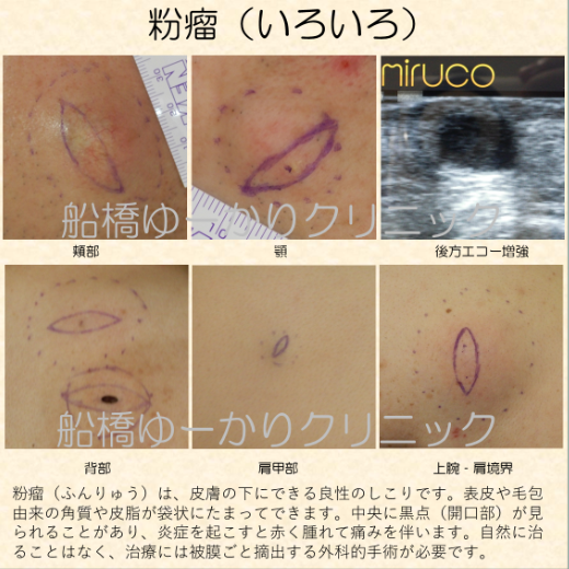 粉瘤（アテローマ）の症例写真