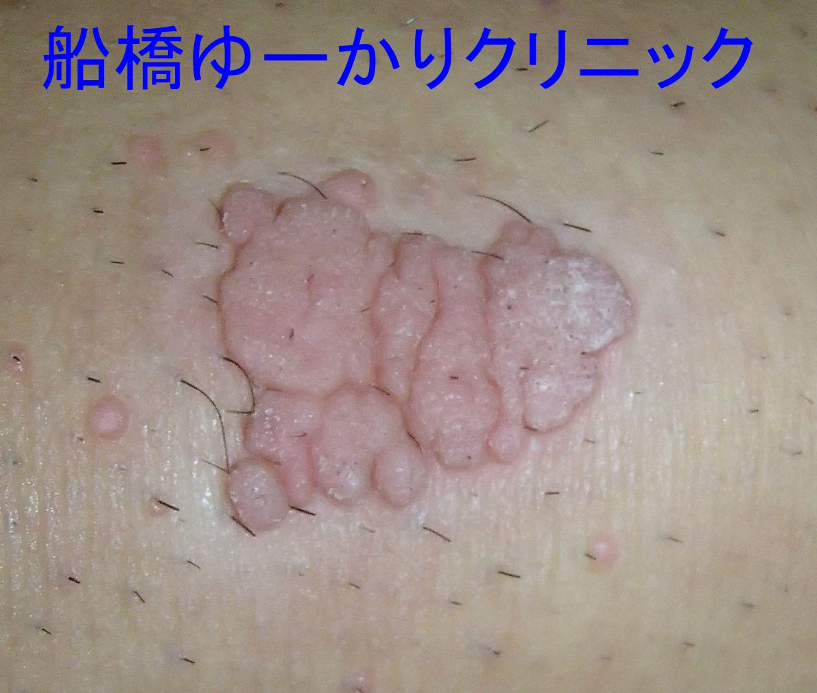 ウイルス性いぼ