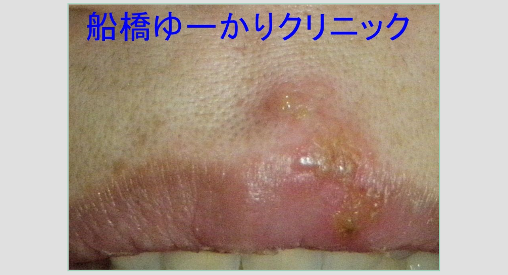 口唇ヘルペス 治療前