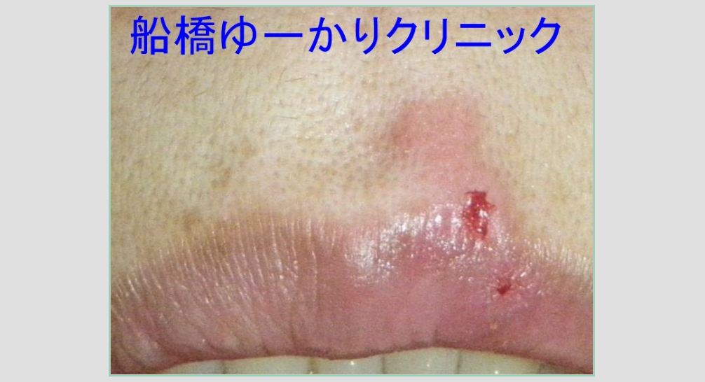 口唇ヘルペス 内服7日後