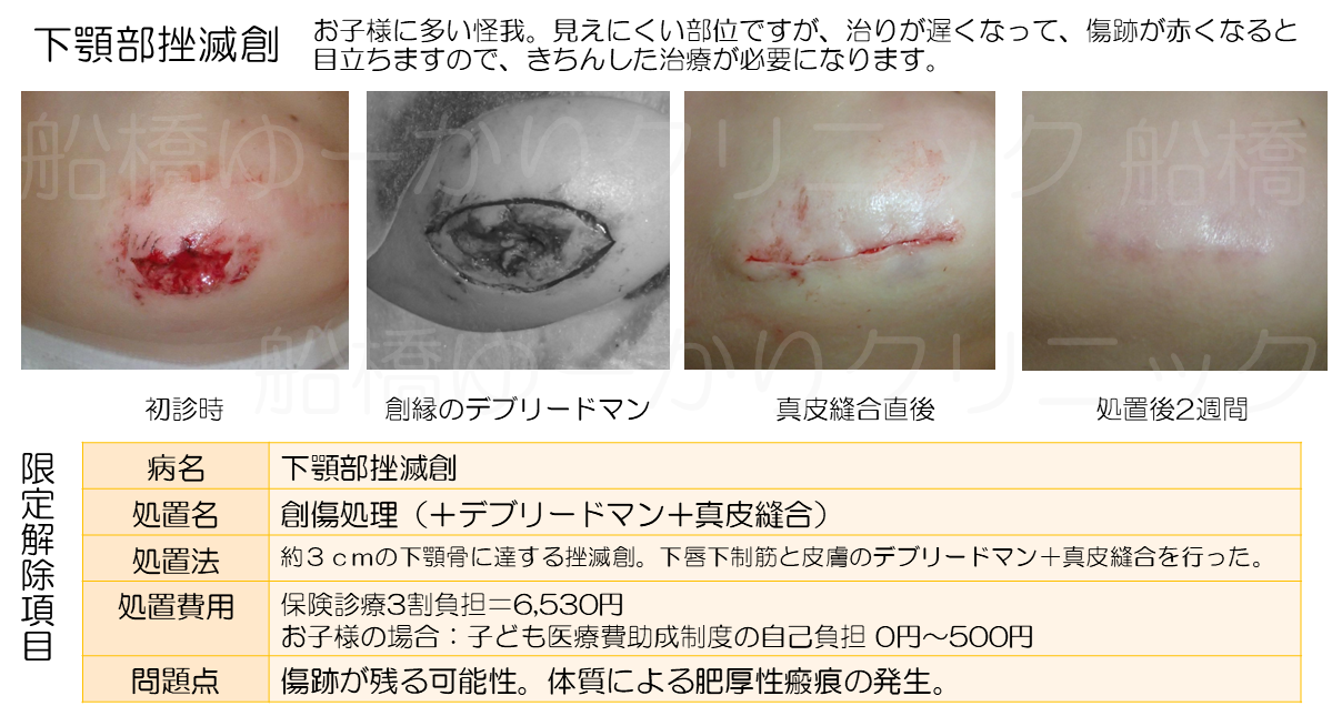 下顎部挫滅創 治療経過