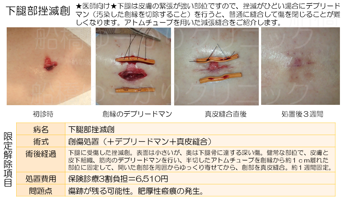 下腿部挫滅創 治療経過