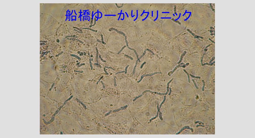 マラセチア菌画像