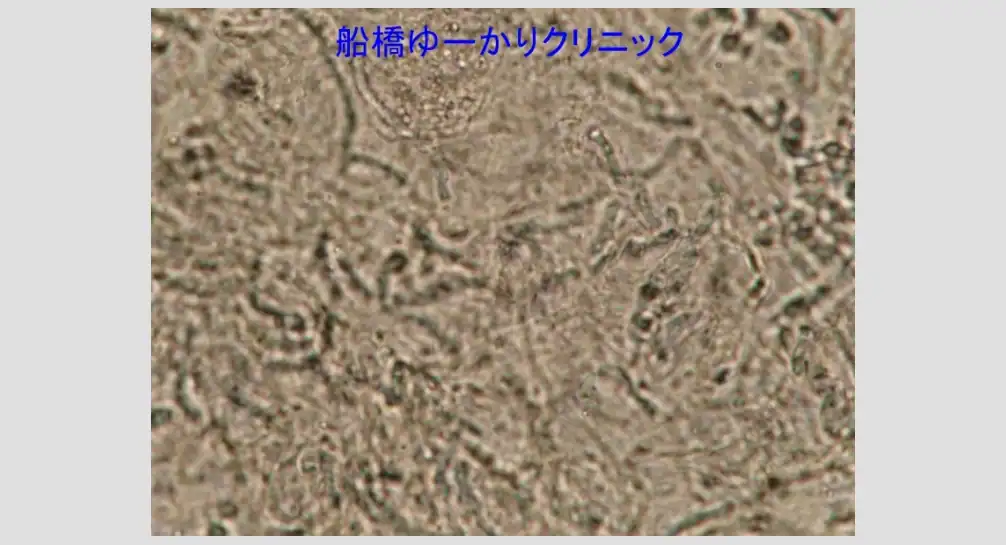 マラセチア菌画像2