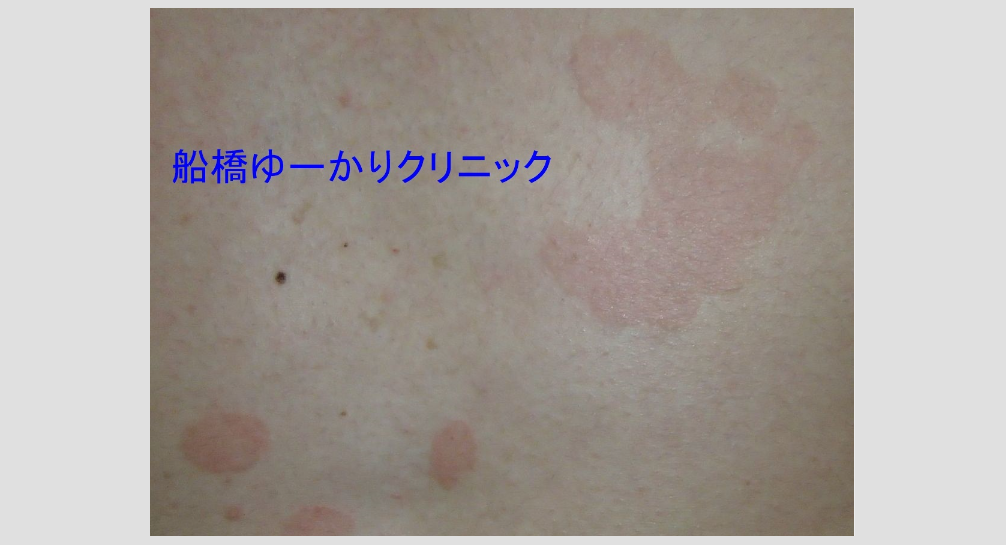 マラセチア 顕微鏡画像1