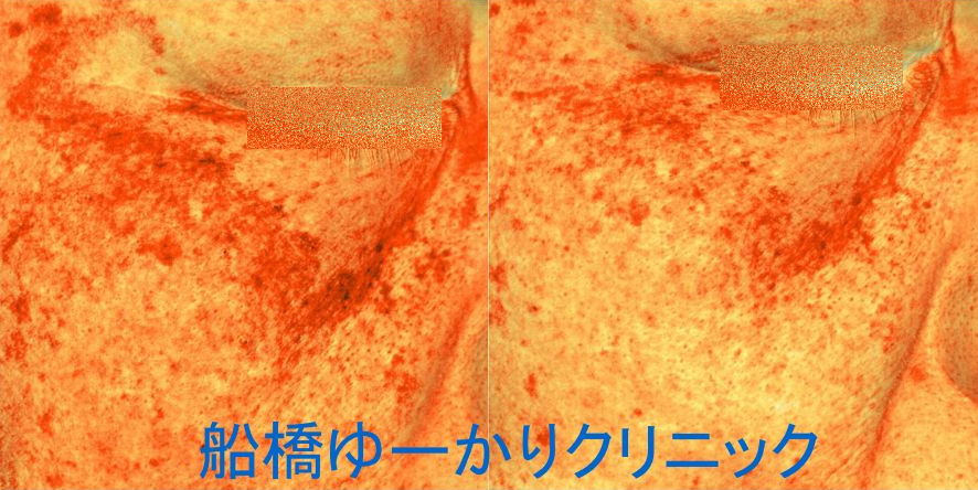 肝斑治療症例1 Before / After
