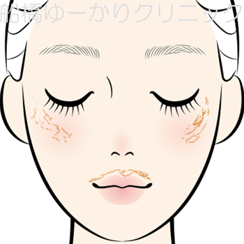 肝斑のイラスト
