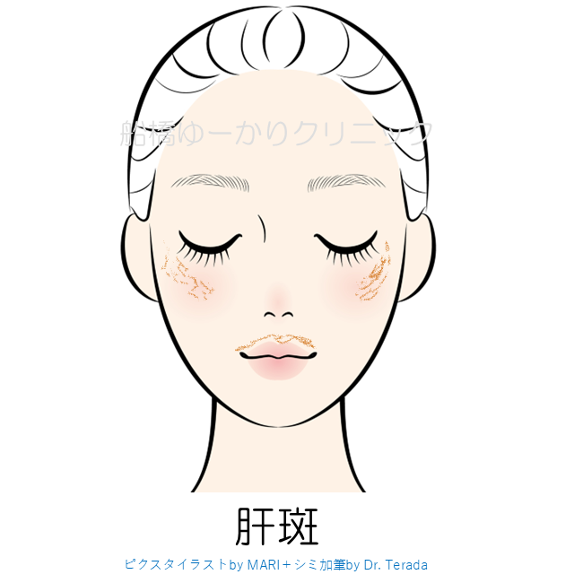 肝斑のアイコン