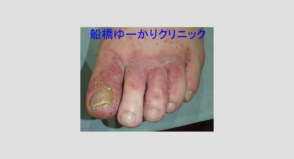 細菌感染を伴う白癬4