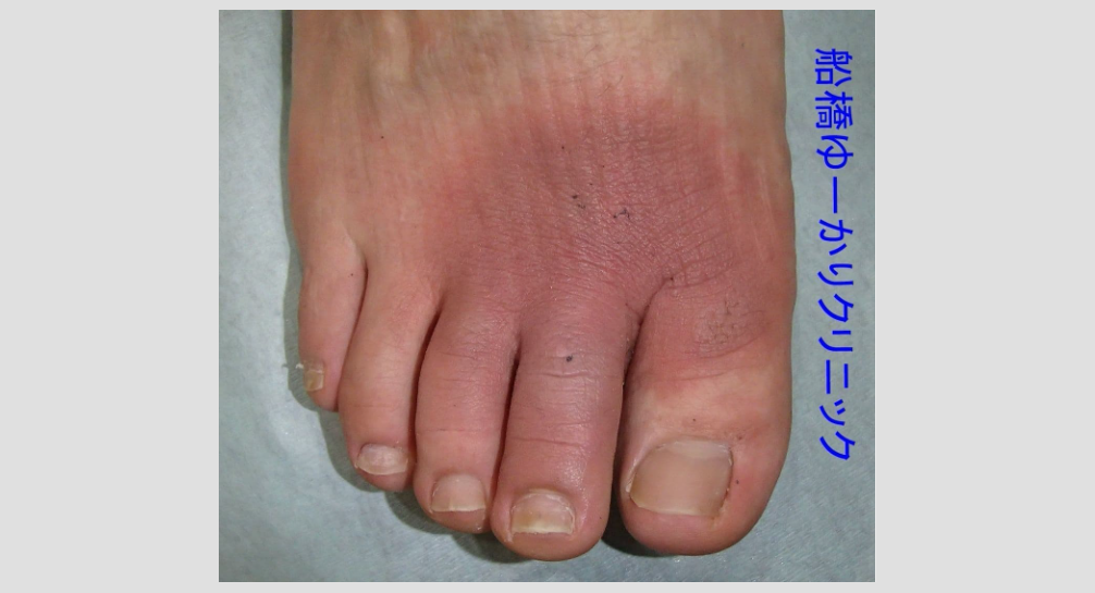 細菌感染を伴う白癬2