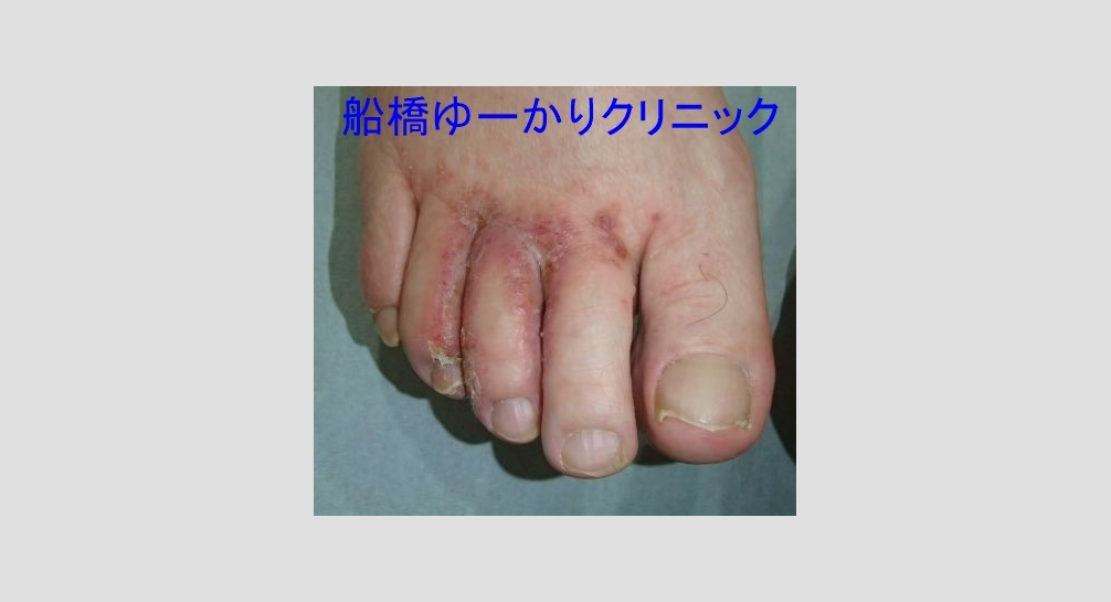 細菌感染を伴う白癬3