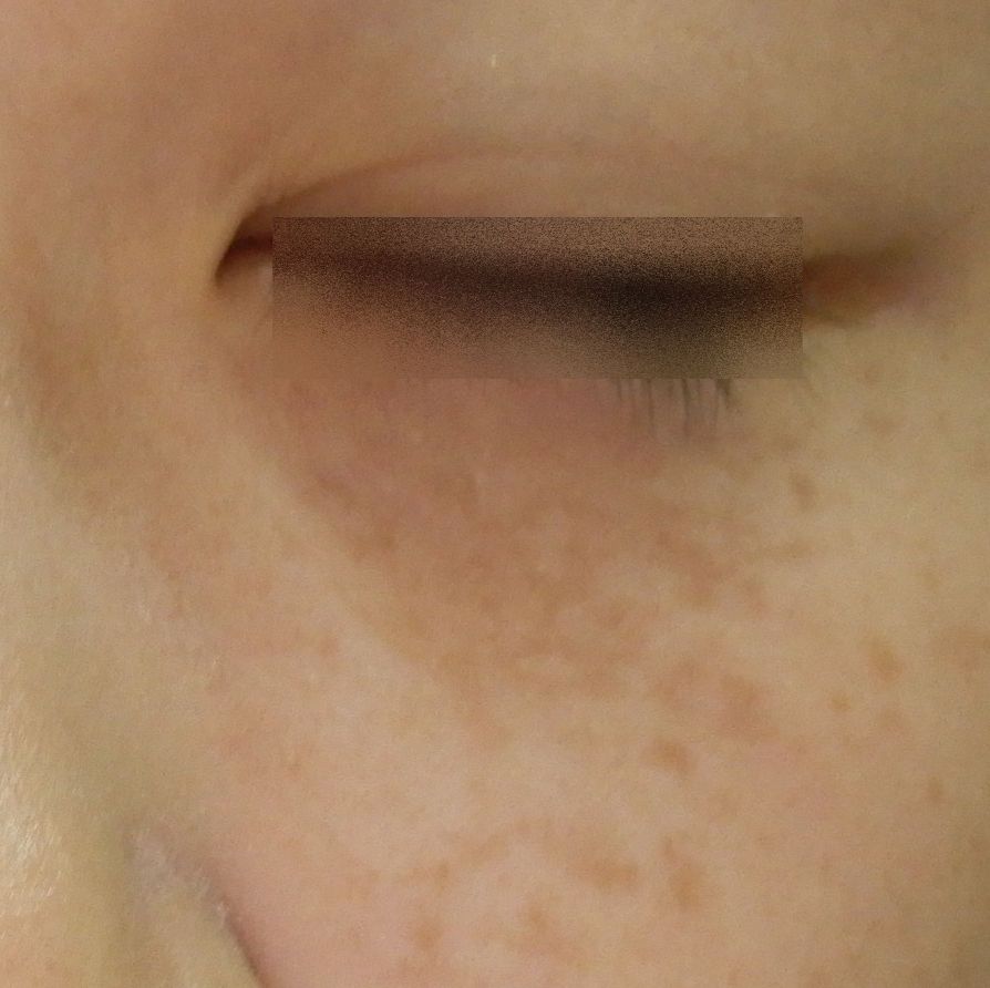 レーザー照射前太田母斑