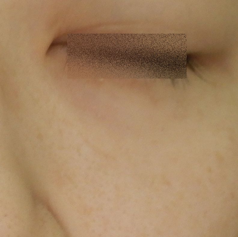 レーザー照射4回後太田母斑