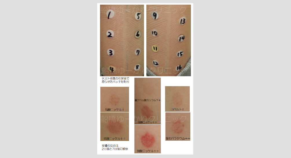 金属パッチテストのテスト時の写真