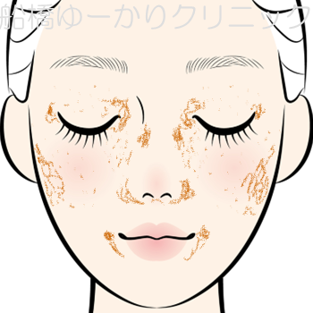 炎症性色素沈着のイラスト