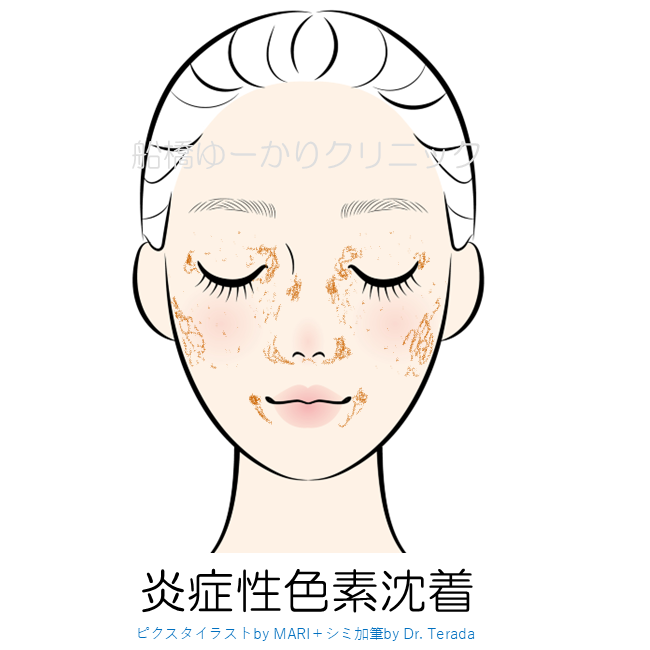 炎症性色素沈着のアイコン