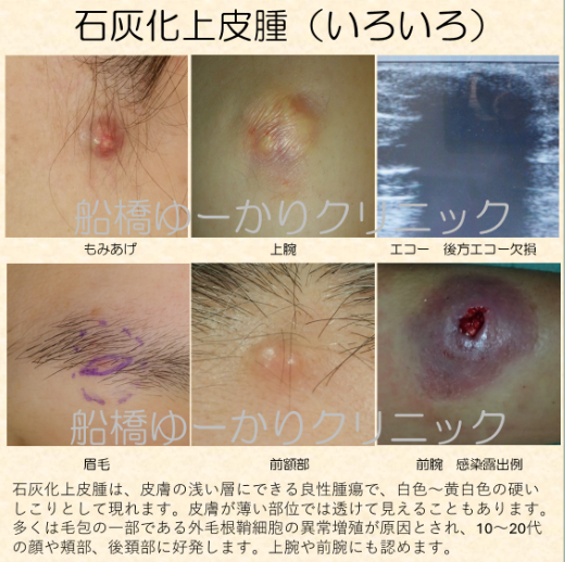 石灰化上皮腫の症例写真