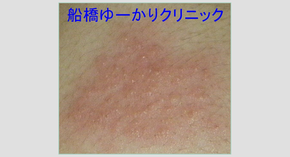 背部帯状疱疹 治療前