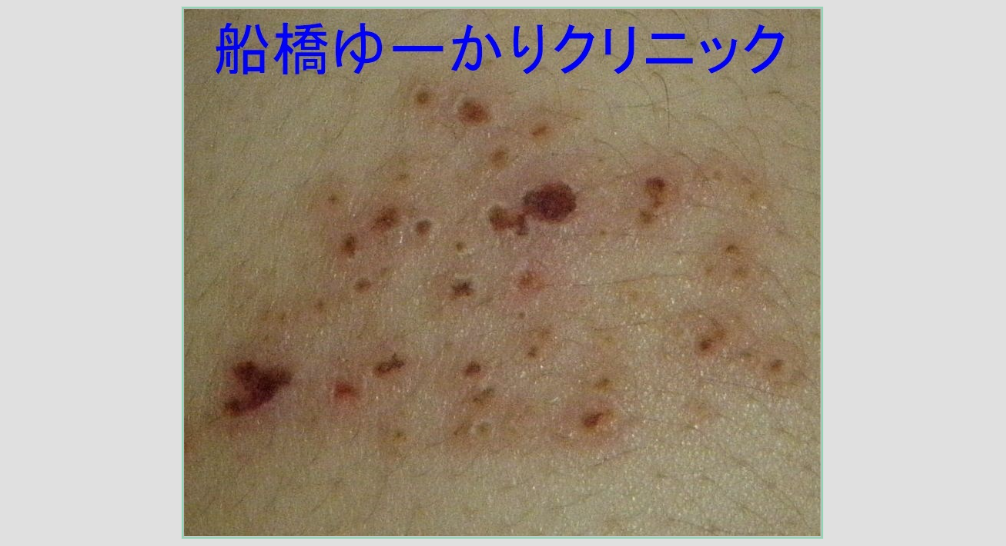 背部帯状疱疹 内服6日後