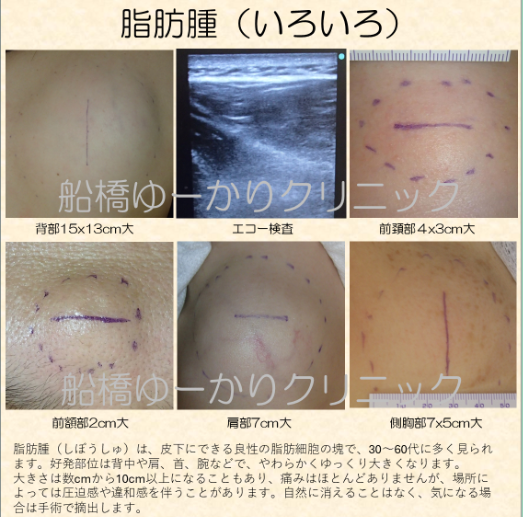 脂肪腫の症例写真