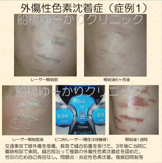 外傷性色素沈着症 治療経過