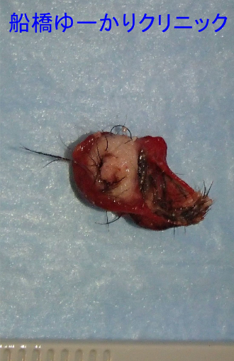 皮様嚢腫 摘出組織