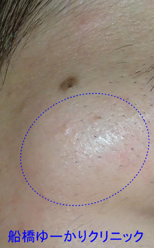 皮様嚢腫 術前