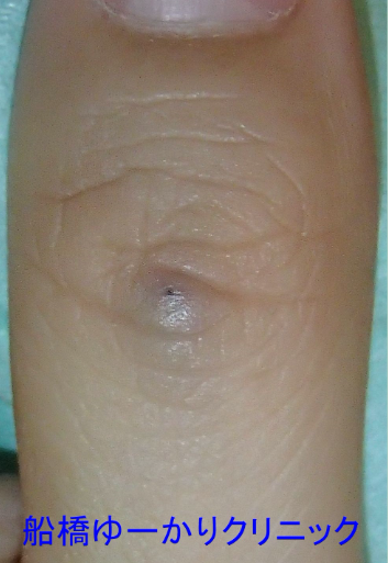 汗管腫 初診時