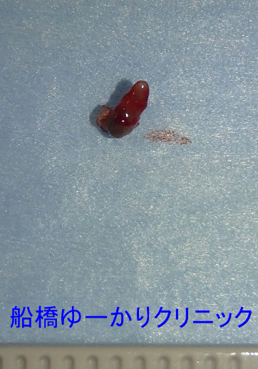 汗管腫 摘出組織