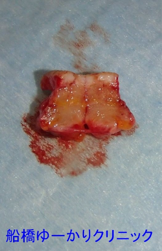 皮膚線維腫 摘出組織