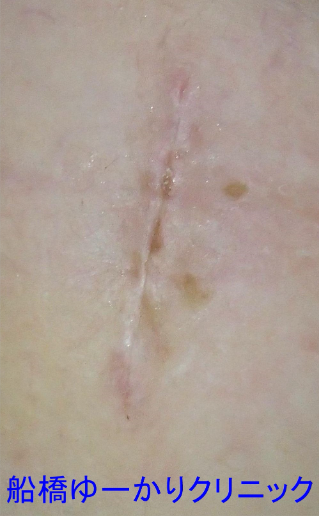 皮膚線維腫 術後1週間