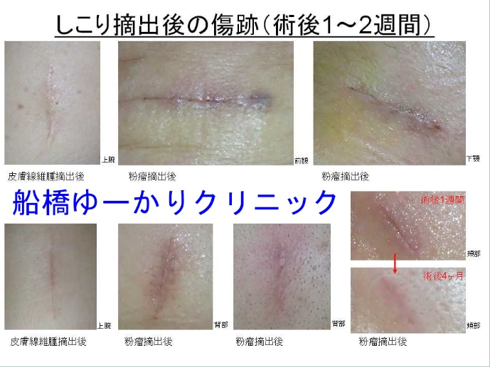 しこり摘出手術後の傷跡の経過