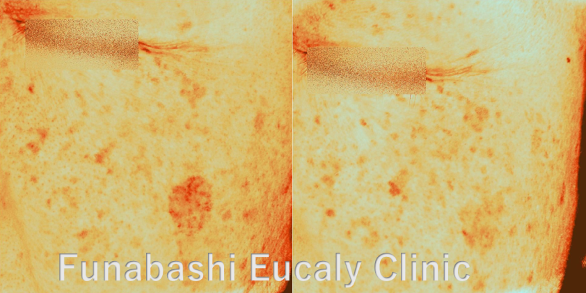 日光黒子治療症例3 Before / After