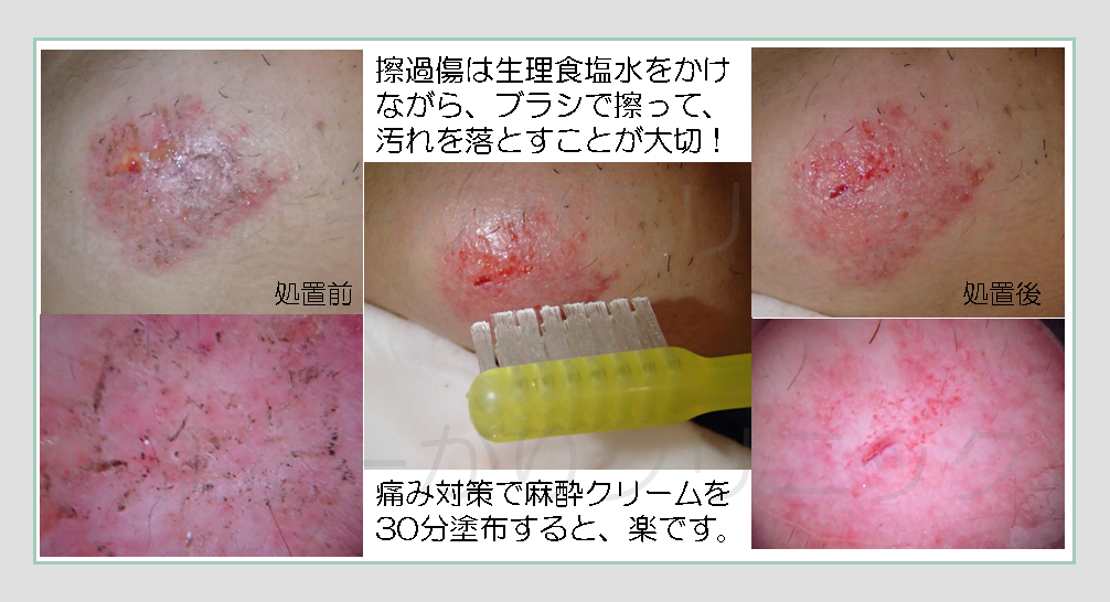 擦り傷の処置方法