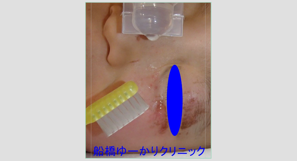 生理食塩水でブラッシング