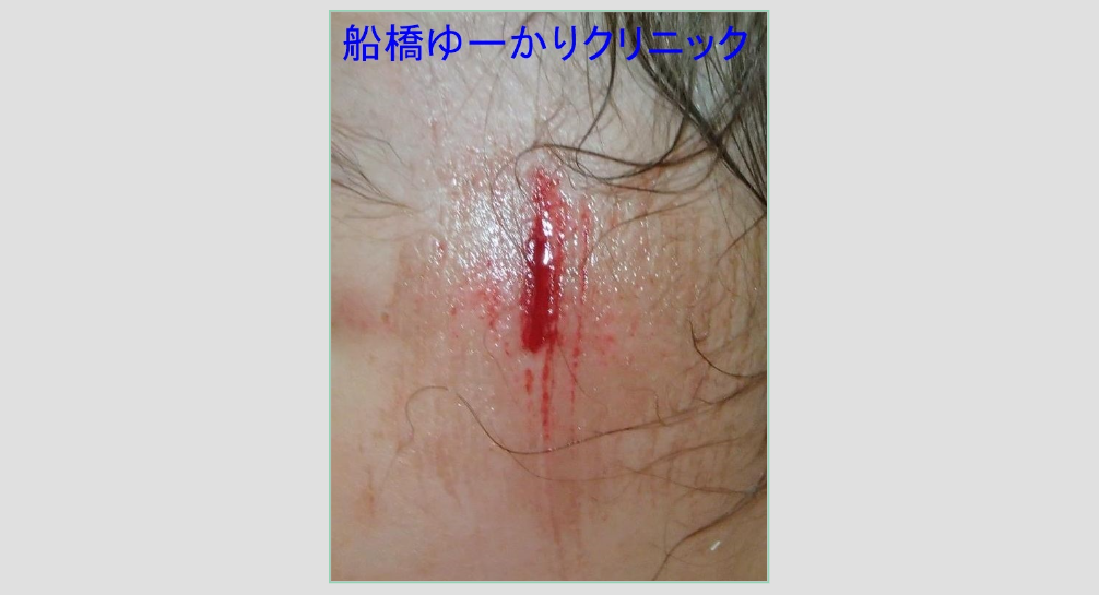 擦り傷 受診時