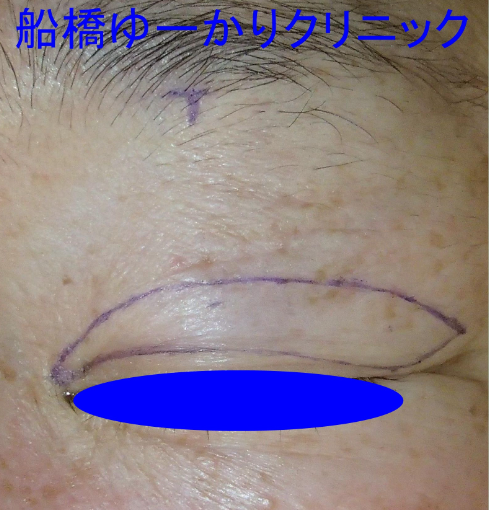 皮膚の切除範囲