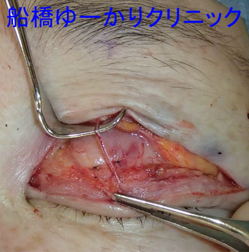腱膜を瞼板に固定