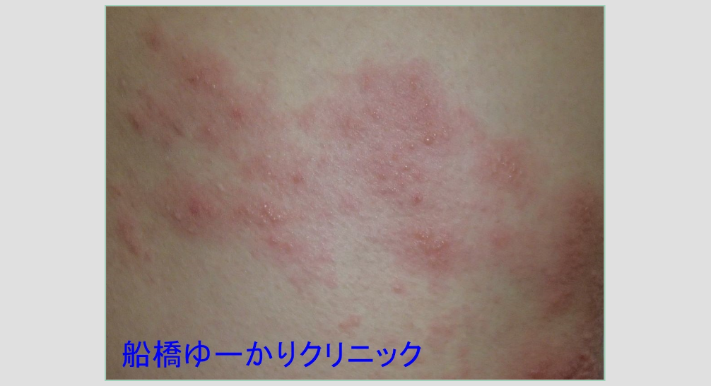 右胸部帯状疱疹 治療前